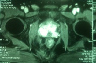 Hình 3 12 Hình chụp cắt lớp vi tính có tiêm thuốc cản quang ― Nguồn Lương Văn 1