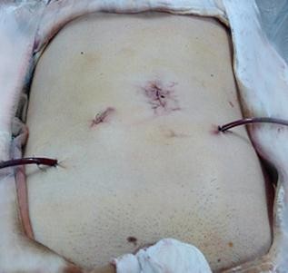 Hình 3 15 Hình ảnh sau khi PTNS thành công đường mổ ngắn ― Nguồn Hà Ngọc T 3