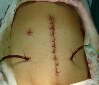 Hình 3 16 Hình ảnh sau khi PTNS thất bại chuyển phẫu thuật mở đường mổ dài 4