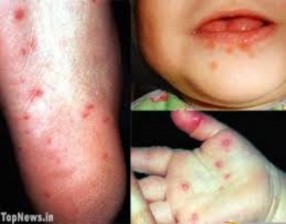 Nguồn Intellegentdental com Nguồn Medicinenet com Hình 1 4 Hình ảnh lâm sàng của Tay 2