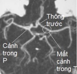 B C D Hình 3 1 Minh họa cấp máu bàng hệ cho động mạch não trước và động 3