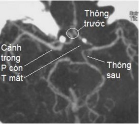 D Hình 3 1 Minh họa cấp máu bàng hệ cho động mạch não trước và động mạch 4