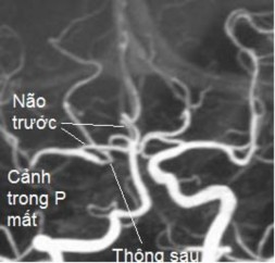 Hình 3 1 Minh họa cấp máu bàng hệ cho động mạch não trước và động mạch não 5