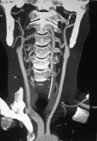 Hình 3 2a Minh họa tắc động mạch cảnh trong hai bên – ca đầu tiên Bệnh nhân 1