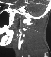 Hình 3 2a Minh họa tắc động mạch cảnh trong hai bên – ca đầu tiên Bệnh nhân 2