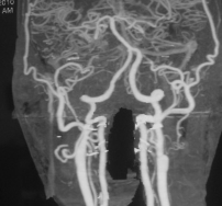 Hình 3 2b Minh họa tắc động mạch cảnh trong hai bên hai ca còn lại TVG 74 tuổi 3