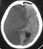 Hình 3 3 Tổn thương toàn bộ bán cầu sau tắc động mạch cảnh trong Hình 3 4 4