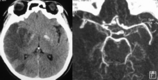 Hình 3 6 Tổn thương phần lớn vùng tưới máu động mạch não giữa chừa lại 5