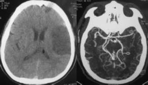 Hình 3 7 Tổn thương một vùng vỏ thuộc phân nhánh nông của động mạch não 6