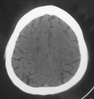 Tương quan bàng hệ và kết cục của các nhóm nhồi máu não 120 100 80 60 40 20 0 7