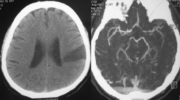 Tương quan bàng hệ và kết cục của các nhóm nhồi máu não 120 100 80 60 40 20 0 8