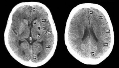 Hình 2 1 Các phân vùng chấm điểm ASPECTS Nguồn Pexman JHW 2001 107 Đánh giá tổn 1