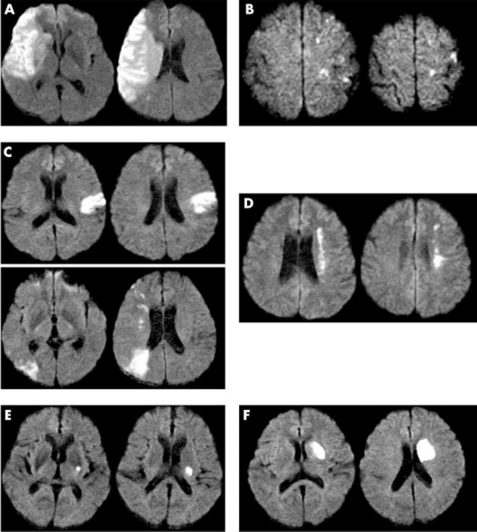 Hình 2 2 Phân vùng tổn thương não theo Bang A Nhồi máu não thùy B Nhồi máu nông 2