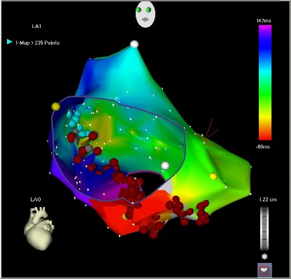 Hình 4 4 Triệt đốt trong buồng nhĩ phải bản đồ điện thế hoạt động 3 1