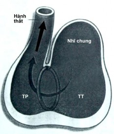 Hình 1 2 Giả thuyết về sự hình thành bệnh TPHĐR 43 Anderson và cộng sự xếp 3