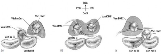 Hình 1 3 Minh họa hình thành của nón dưới van đại động mạch a Tương quan bình 5