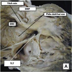 Hình 1 5 TPHĐR thể TLT A TPHĐR với lỗ TLT dưới van ĐMC B Minh họa thương tổn 6