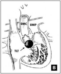 Hình 1 5 TPHĐR thể TLT A TPHĐR với lỗ TLT dưới van ĐMC B Minh họa thương tổn 7