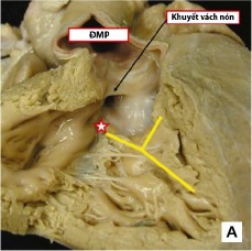 Hình 1 6 TPHĐR thể TLT với lỗ thông dưới hai van động mạch A TPHĐR với lỗ TLT 8