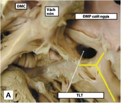 Hình 1 7 TPHĐR thể chuyển gốc động mạch A TPHĐR với lỗ TLT dưới van ĐMP B 1