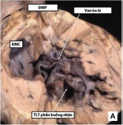 Hình 1 8 TPHĐR thể TLT biệt lập A TPHĐR với lỗ TLT biệt lập phần buồng nhận 3