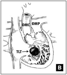 Hình 1 8 TPHĐR thể TLT biệt lập A TPHĐR với lỗ TLT biệt lập phần buồng nhận 4