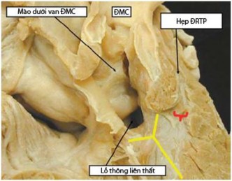 Hình 1 9 TPHĐR TLT dưới van ĐMC kèm theo thương tổn hẹp ĐRTP 39 1 2 2 4 Thương 5