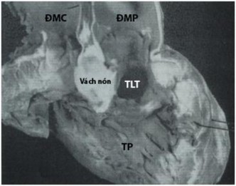 Hình1 10 Vách nón phì đại gây hẹp đường ra thất trái trong thương tổn Taussig 6