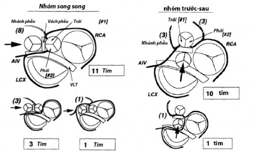 Hình 1 11 Giải phẫu ĐMV trong bất thường Taussig Bing Nhóm bệnh nhân có tương 7