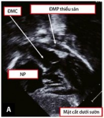 Hình 1 12 Mặt cắt dưới sườn trục dọc trong chẩn đoán TPHĐR A Hình ảnh của 1
