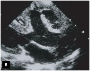 Hình 1 12 Mặt cắt dưới sườn trục dọc trong chẩn đoán TPHĐR A Hình ảnh của 2