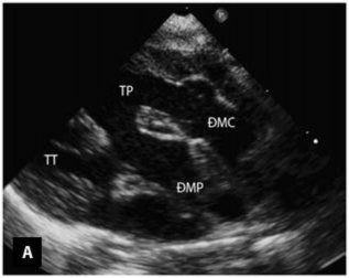 Hình 1 13 Mặt cắt cạnh ức trong chẩn đoán TPHĐR A Hình ảnh TPHĐR thể chuyển 3