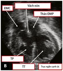 Hình 1 13 Mặt cắt cạnh ức trong chẩn đoán TPHĐR A Hình ảnh TPHĐR thể chuyển 4