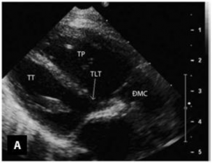 Hình 1 14 Hình ảnh TPHĐR thể TLT sử dụng mặt cắt cạnh ức trục dài 34 Mặt 5
