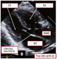 Hình 1 14 Hình ảnh TPHĐR thể TLT sử dụng mặt cắt cạnh ức trục dài 34 Mặt 6