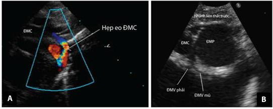 Hình 1 15 Mặt cắt trên ức trong chẩn đoán TPHĐR A Hình ảnh hẹp eo ĐMC sử 7