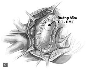 Hình 1 18 Phẫu thuật sửa toàn bộ TPHĐR thể TLT A TPHĐR thể TLT qua đường bộc 1