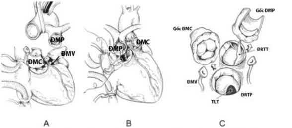 Hình 1 22 Phẫu thuật Nikaidoh cải tiến A Gốc ĐMC bao gồm van và ĐMC lên được 2