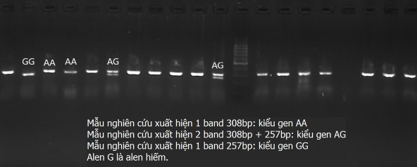 Hình 3 3 Kết quả xác định kiểu gen LRP5 rs41494349 bằng phương pháp RFLP PCR Mẫu 2