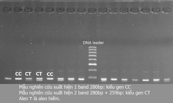 Hình 3 5 Kết quả xác định kiểu gen FTO rs1121980 bằng phương pháp RFLP PCR Mẫu 1 3