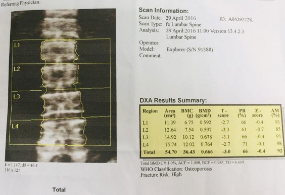 Hình 2 1 Kết quả đo mật độ xương tại cột sống thắt lưng Tại CXĐ đo tại 1