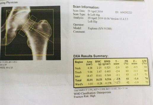 Hình 2 2 Kết quả đo mật độ xương tại cổ xương đùi Cách tính chỉ số T cho 2
