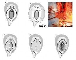 Hình 1 10 Quy trình tạo vạt môi bé đơn thuần trong tái tạo âm đạo 59 A Đường 2