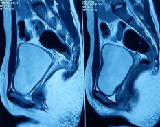 Hình 3 2 Hình ảnh phim cộng hưởng từ vùng tiểu khung Trên kết quả siêu âm và 3