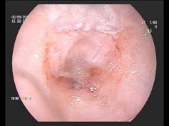 Hình 4 1 Niêm mạc âm đạo sau mổ 4 tháng Có một bệnh nhân có các tuyến tiết 2