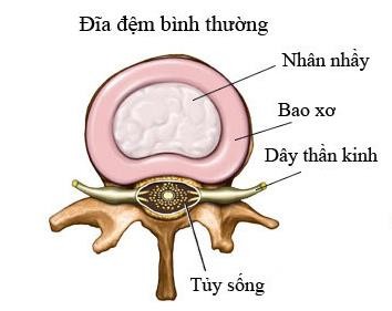 Hình 1 3 Cấu tạo đĩa đệm cột sống 1 2 1 Nhân nhầy Nhân nhầy nằm ở trung 3