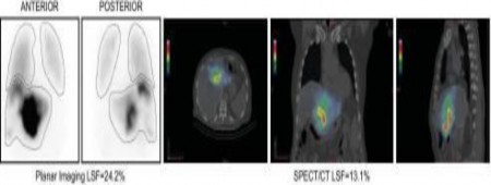 Hình 1 4 Hình ảnh shunt gan – phổi hai kĩ thuật SPECT và SPECT CT Nguồn Mike F 2