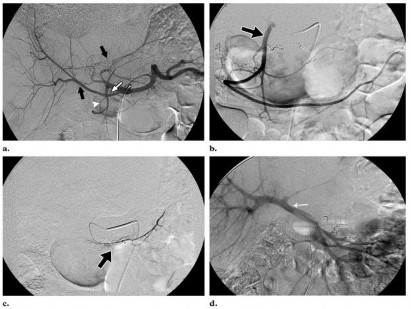 Hình 2 1 Hình ảnh nút bằng coils động mạch vị tá tràng và động mạch vành 1