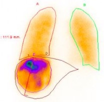 Hình 2 2 Xạ hình shunt gan phổi Sau bơm dược chất phóng xạ 99m Tc – MAA vào 2