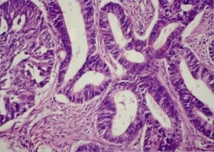 A B Hình 1 1 Vi thể ung thư biểu mô phổi Hình ảnh vi thể ung thư biểu mô phổi 1